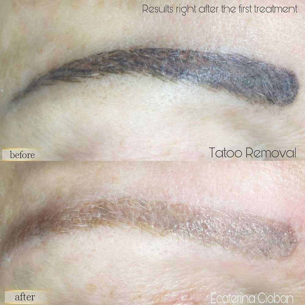 Microblading Removal: When and How to Do It?
