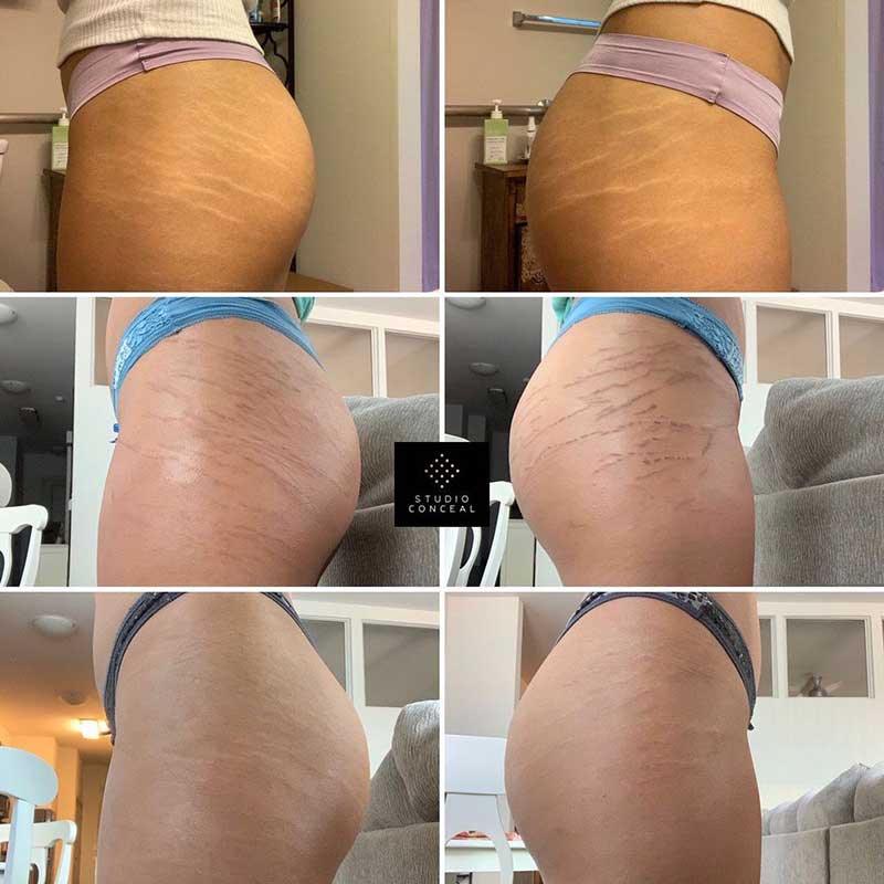 How To Cover STRETCH MARKS on ARMS with MAKEUP (Waterproof Body Makeup)  Does it Transfer? 