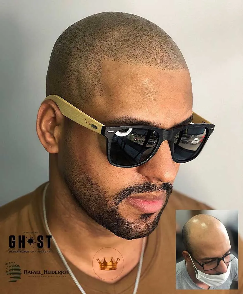 Permanent Makeup - Scalp Micropigmentation - SMP