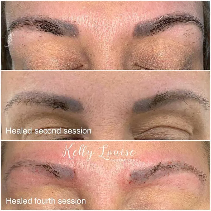 NonInvasive Laser Tattoo Removal For Eyebrows  BROWZ