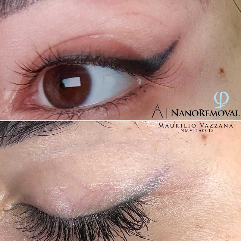 Is Permanent Eyeliner Removal Possible?