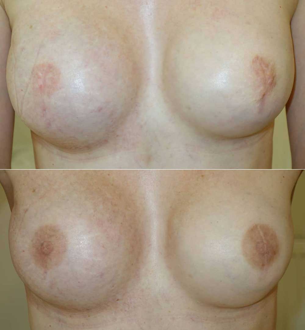 About The Areola And Nipple Tattoo Treatment