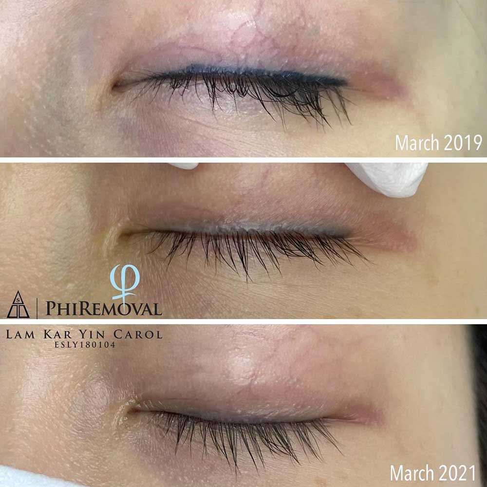 How to remove permanent eyeliner tattoo