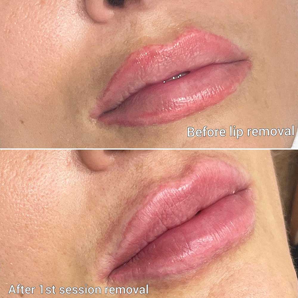 Farrah Forster Permanent Makeup - Client had an old lip tatto that faded  and left behind a liner. First visit is always the correction and a target  color. Never over working the