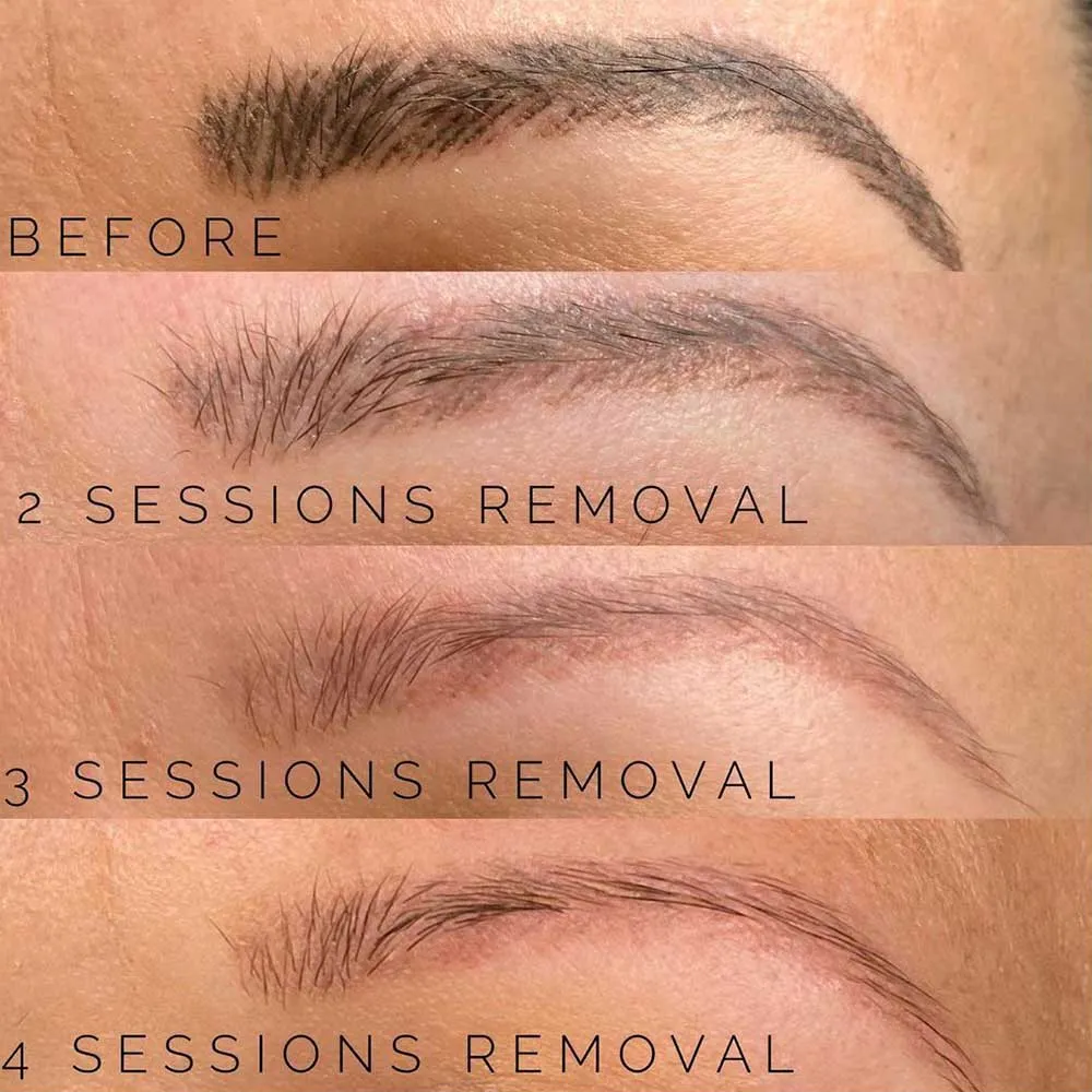 Microblading Removal Los Angeles  Saline Removal  Lily The Pink LA