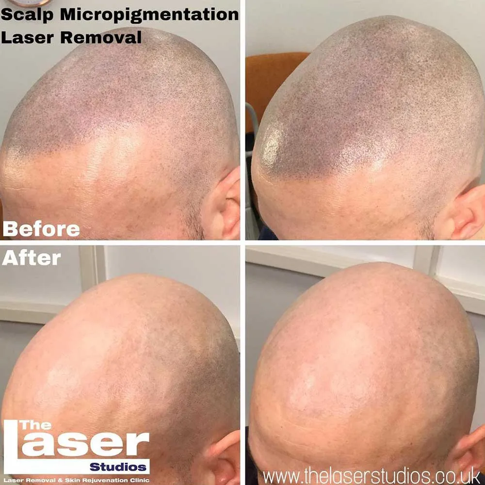 Scalp Micropigmentation Laser Removal