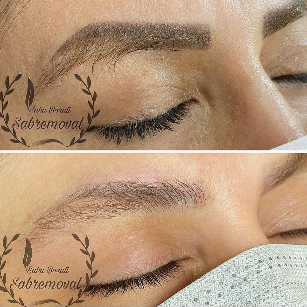 If you got tired of your old microshading, there are 3 efficient ways to get rid of that old eyebrow tattoo.