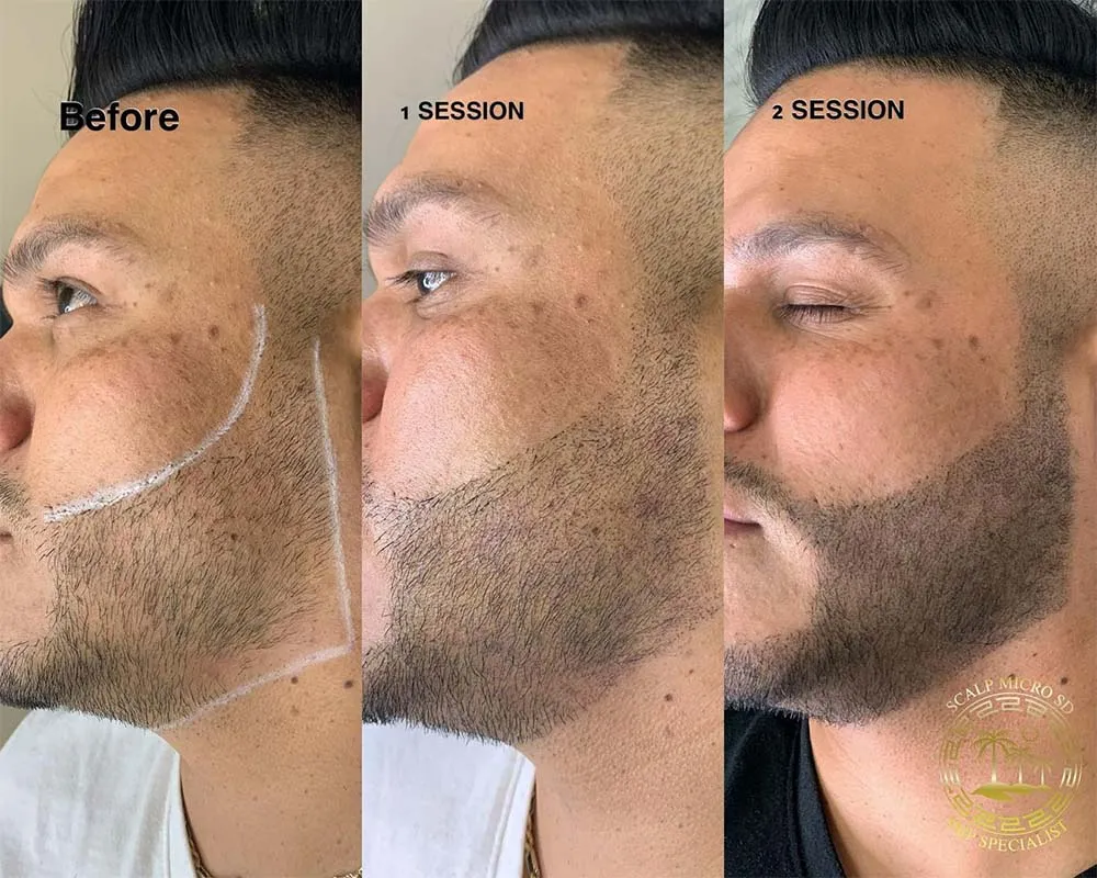 Cosmetic Beard Tattoo - PMU Solutions for Facial Hair Enhancement Cosmetic Beard Tattoo - PMU Solutions for Facial Hair Enhancement