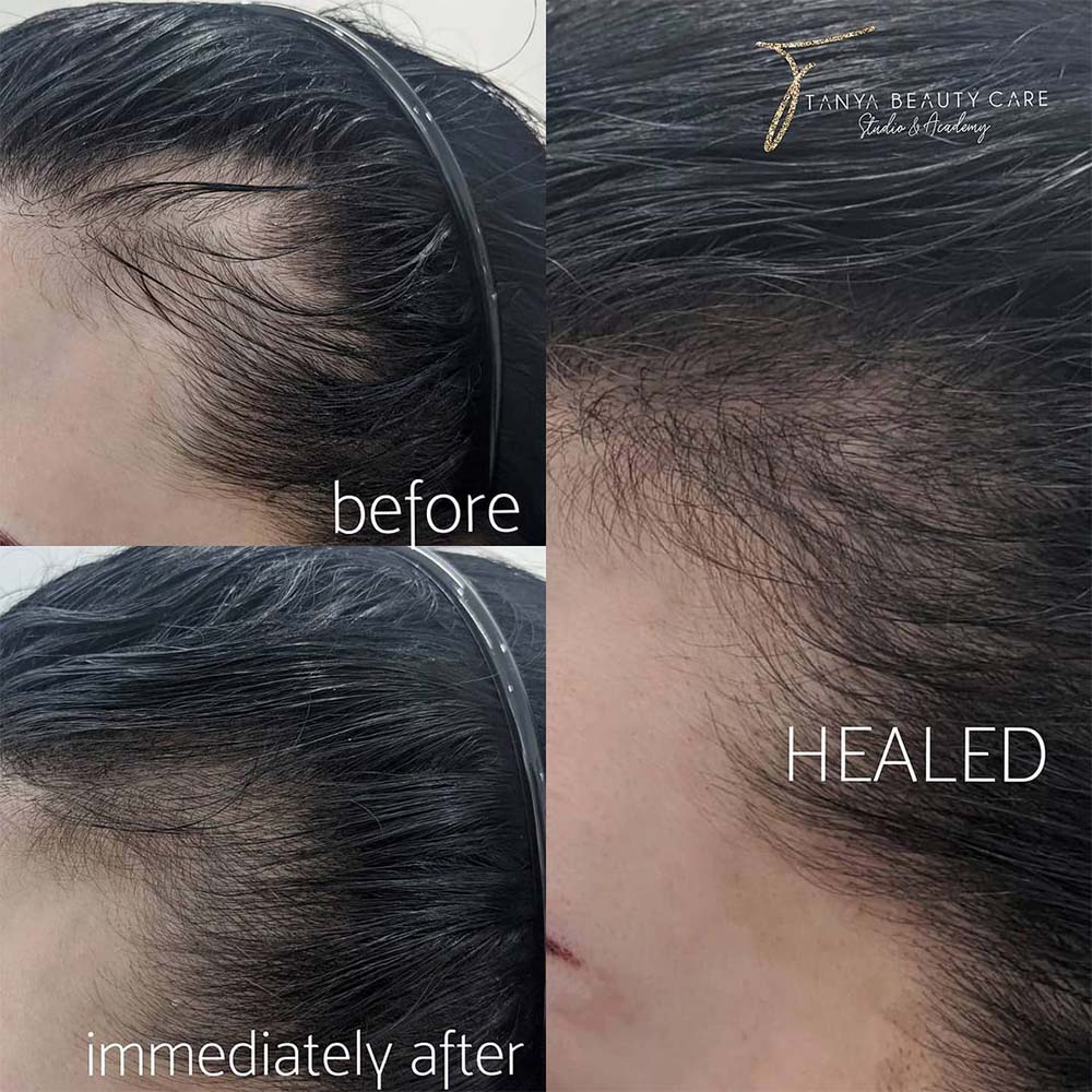 All About Hairline Microblading Aftercare
