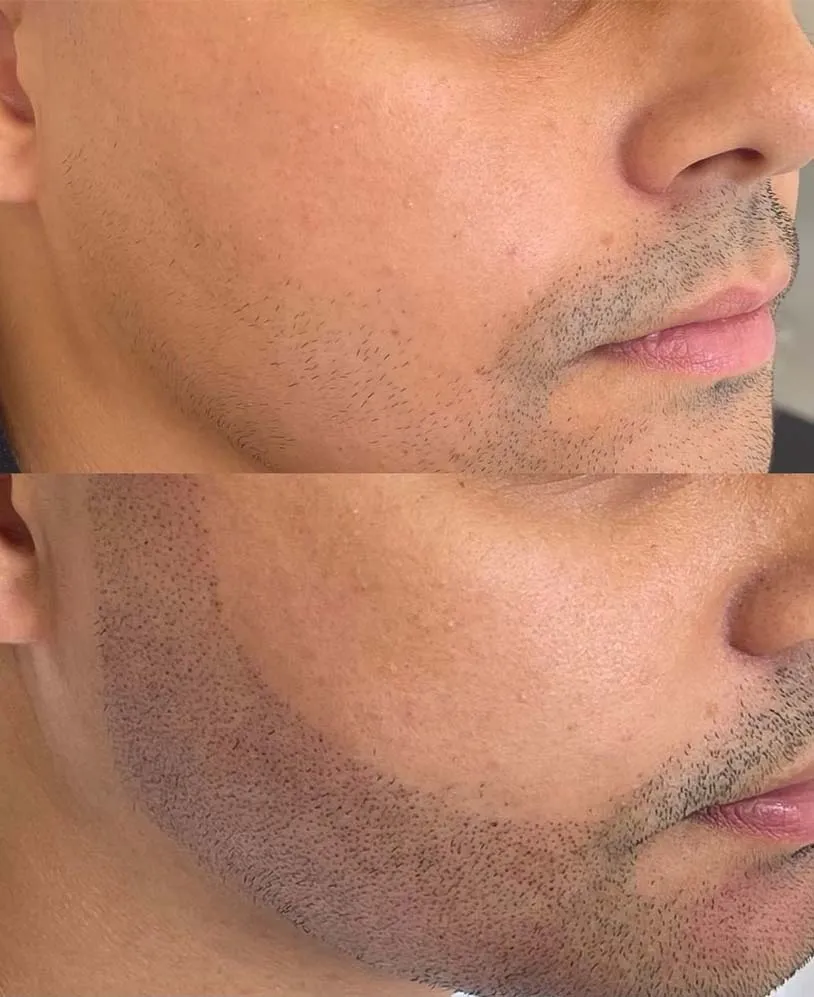Facial Hair Micropigmentation - how long does it last?
