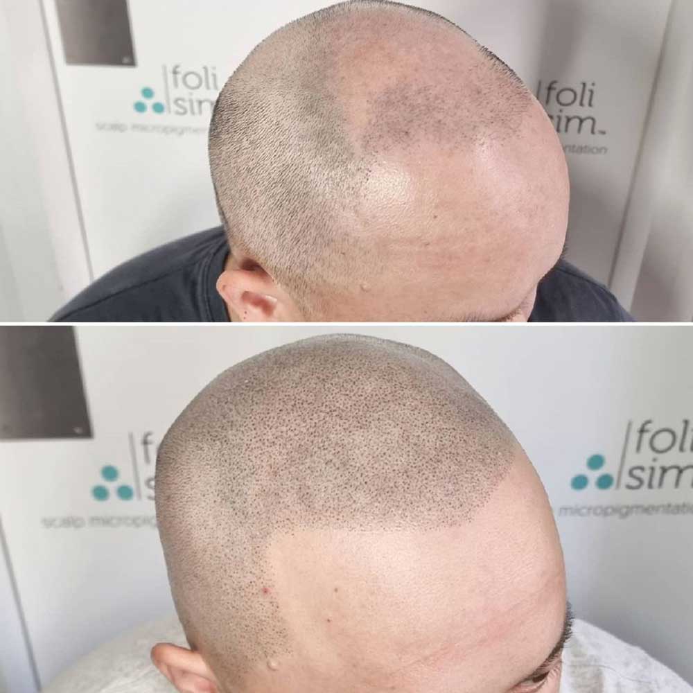 Before and After Scalp Micropigmentation Pictures