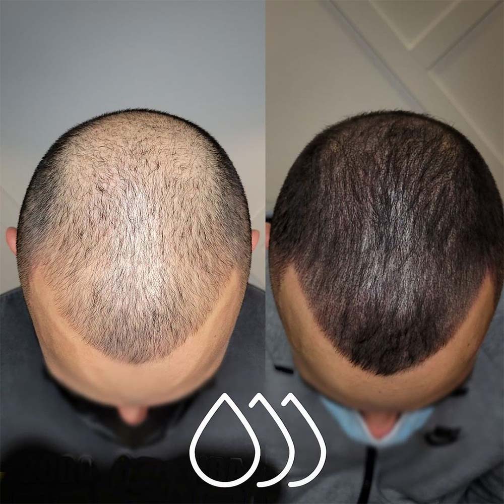 How Much Does Scalp Micropigmentation Cost on Average?
