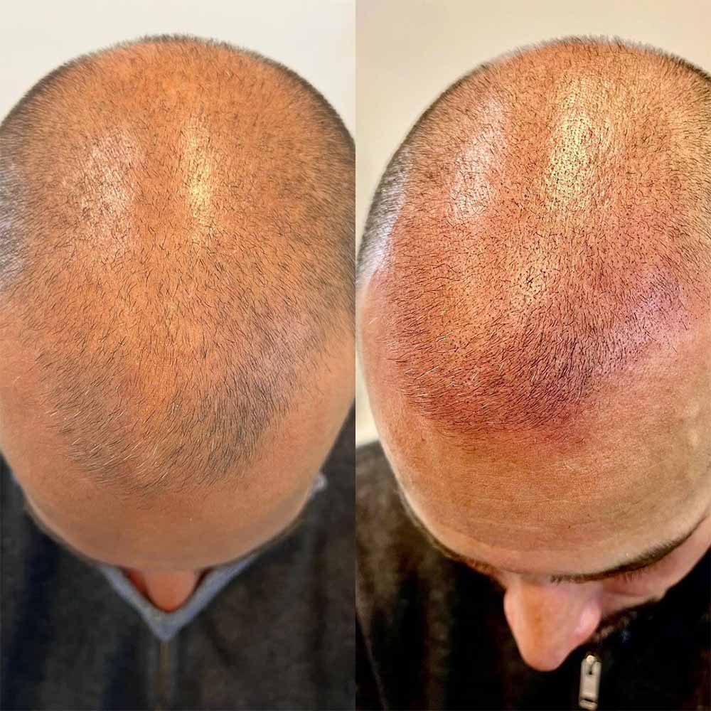 Scalp Micropigmentation Side Effects During the Treatment