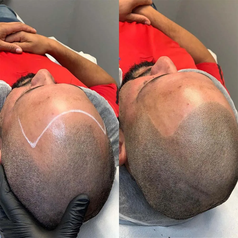 Scalp Micropigmentation: The Ultimate Guide Through SMP