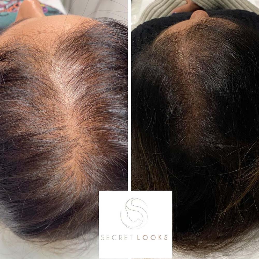 Does the Scalp Micropigmentation Cost Pay Off?