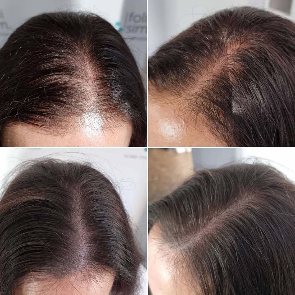 Scalp Micropigmentation