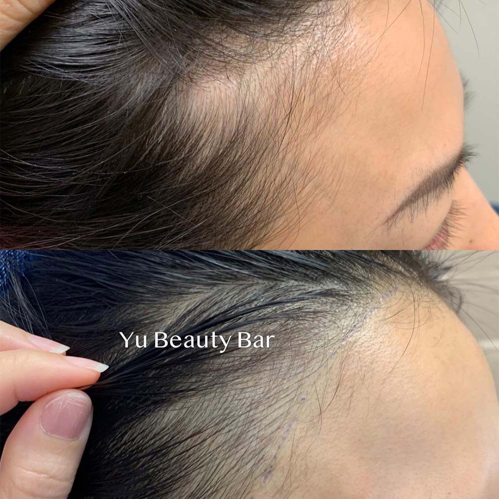 Hairline microblading, also known as scalp microblading or hairline embroidery, is very similar to microblading eyebrows.