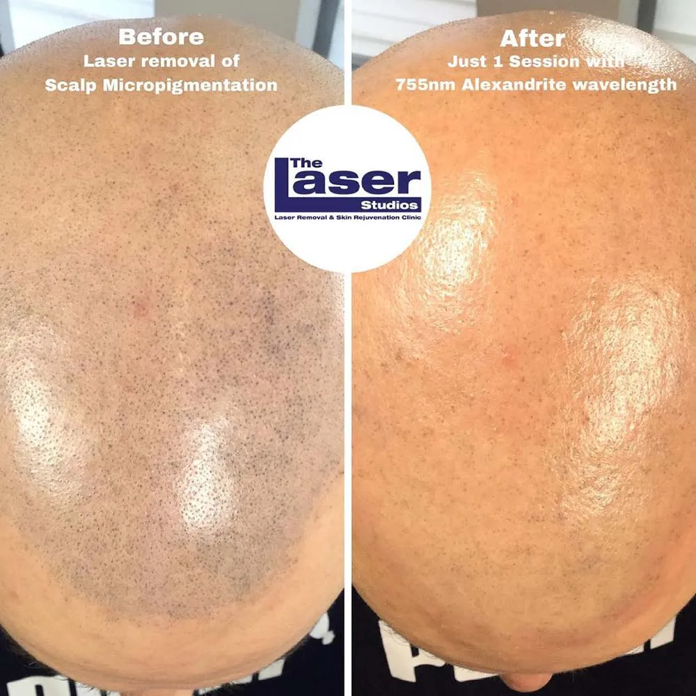 Scalp Micropigmentation Removal - Everything You Should Know