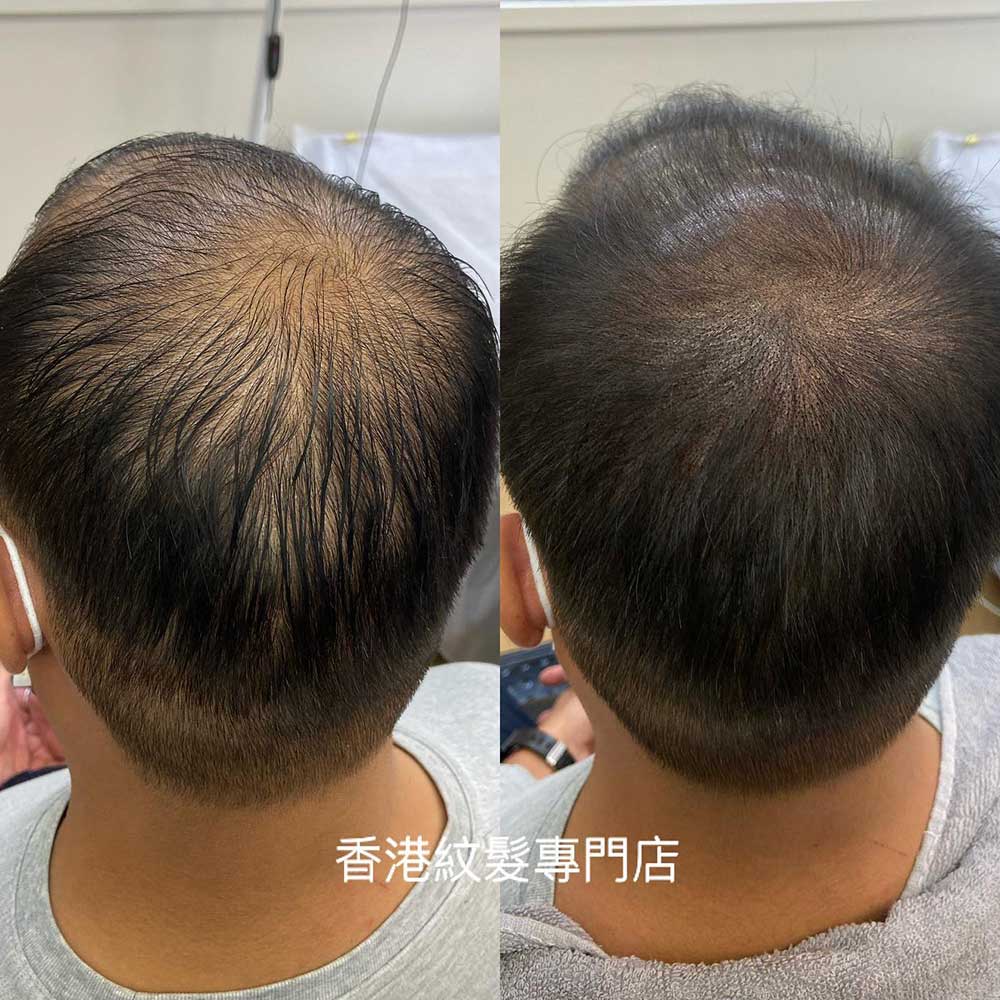 How Is Scalp Micropigmentation with Hair Done?