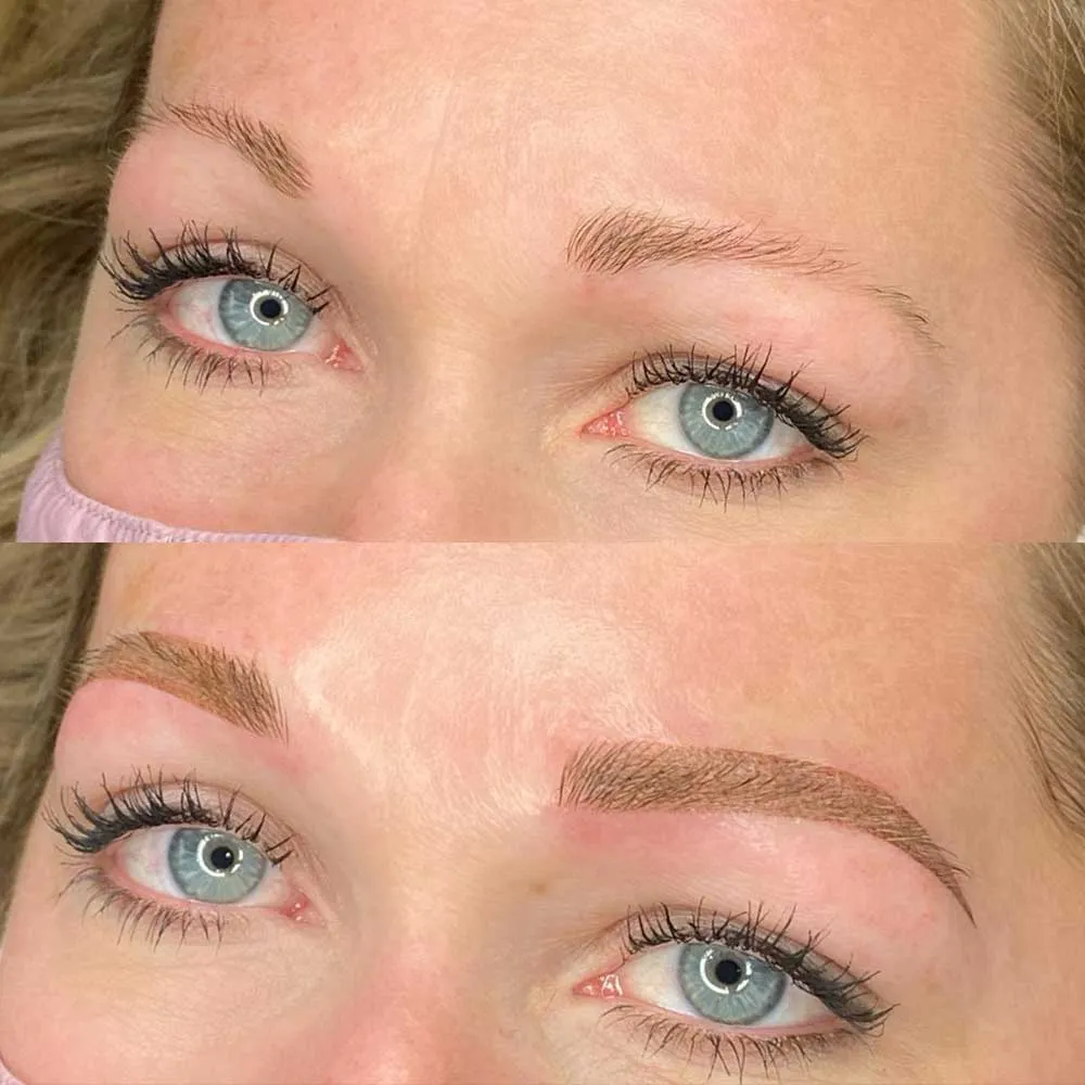 Saline Eyebrow Tattoo Removal Before and After When Is It Better