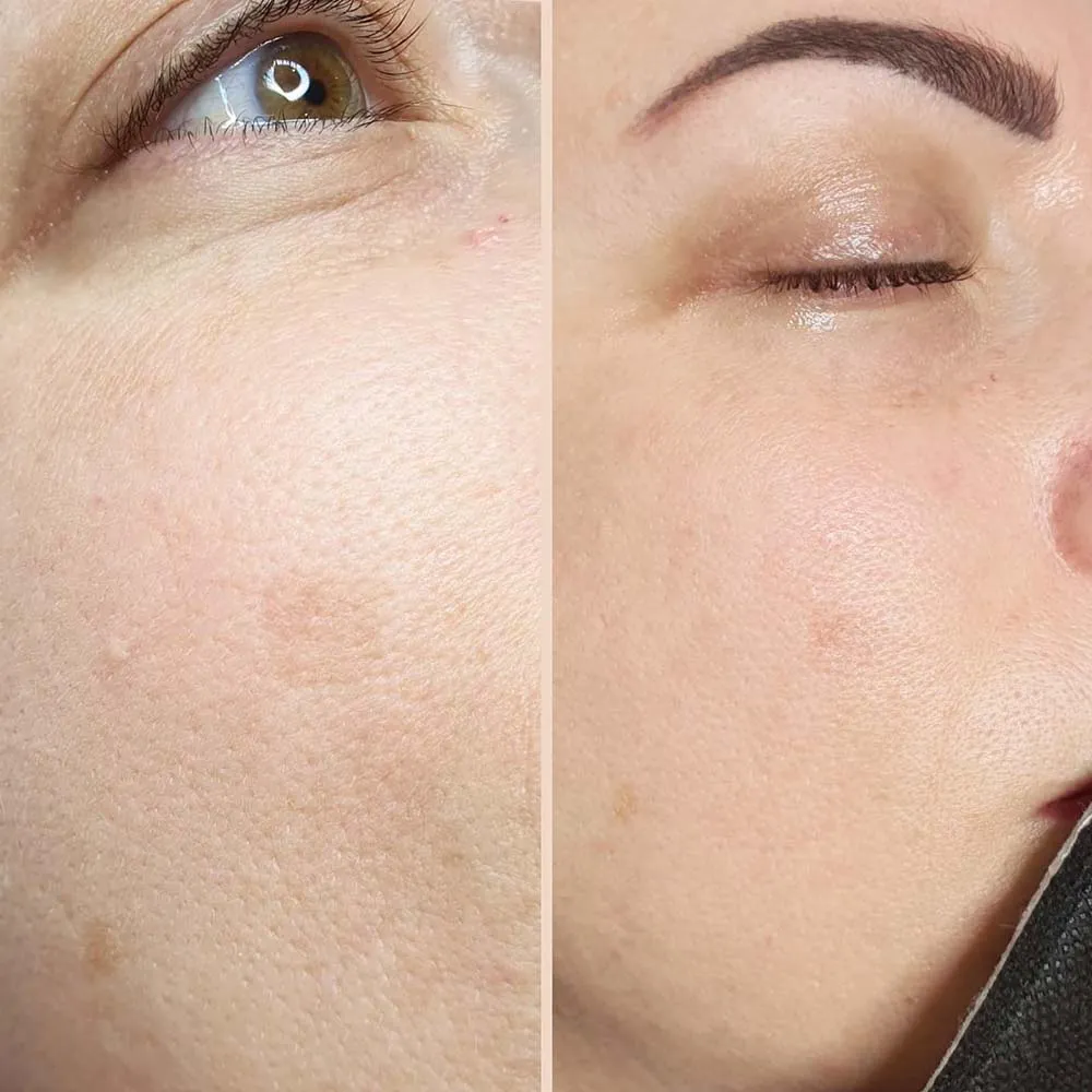 Who Isn’t a Suitable Candidate for Derma Rolling?