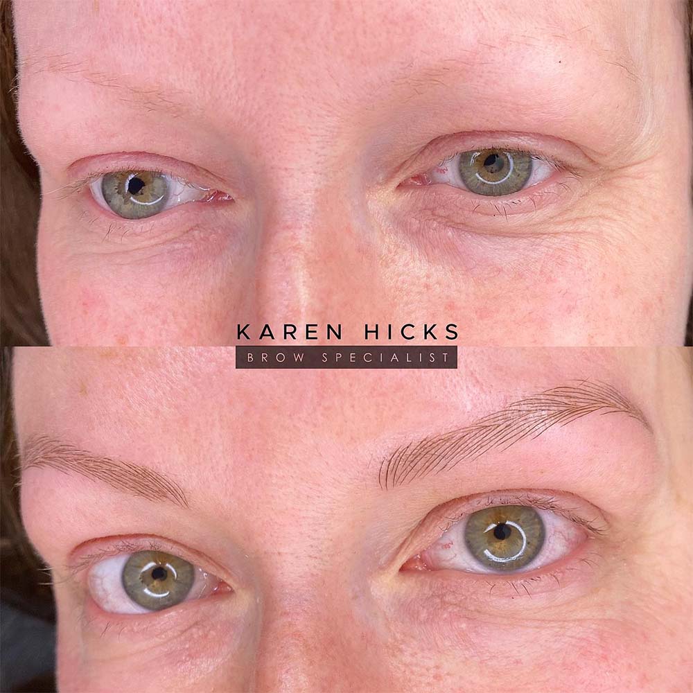 Alopecia Patients Microblading For Complete Brow Loss