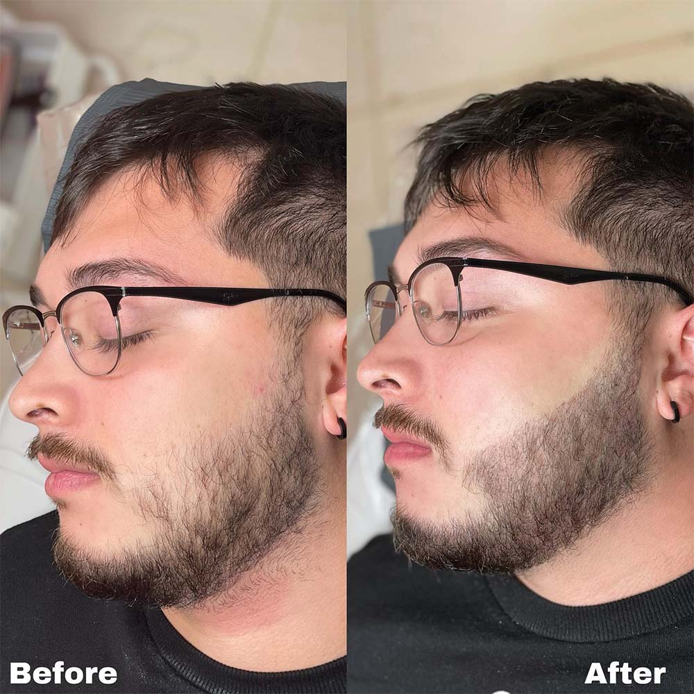 Beard micropigmentation is a form of cosmetic tattooing for facial hair.