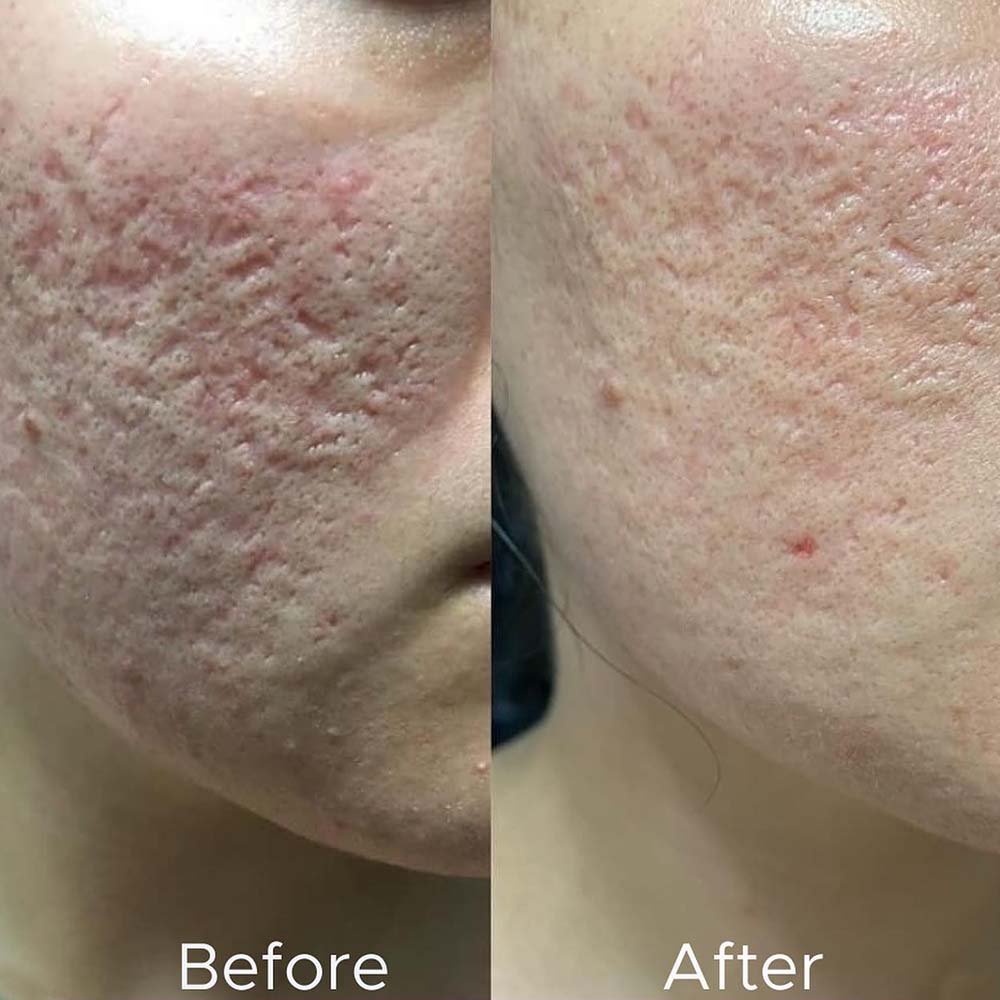 Derma Rolling - A Form Of Microneedling Done With Microneedling Rollers 