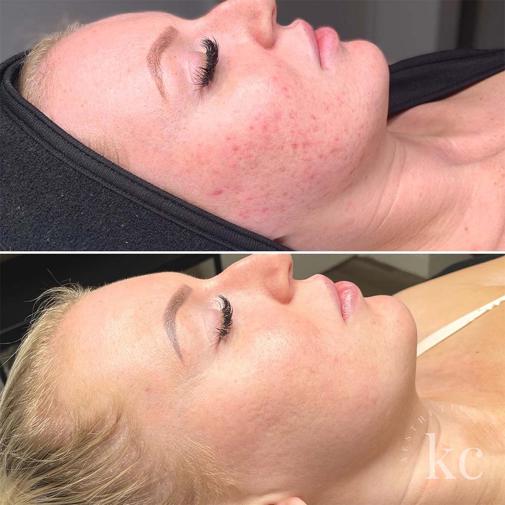Microneedling - A Skin Treatment Used For Improving The Appearance Of The Skin