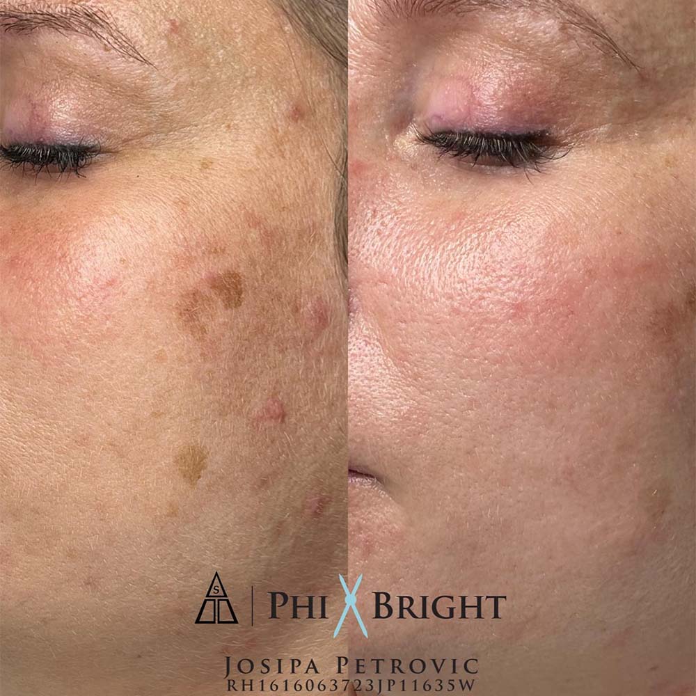 Derma Pen Treatment Is A Form Of Microneedlingf