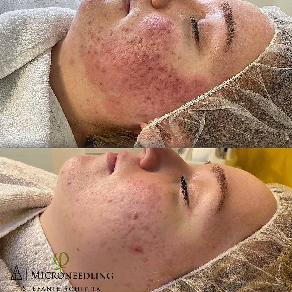 Is the Microneedling Cost Worth It?