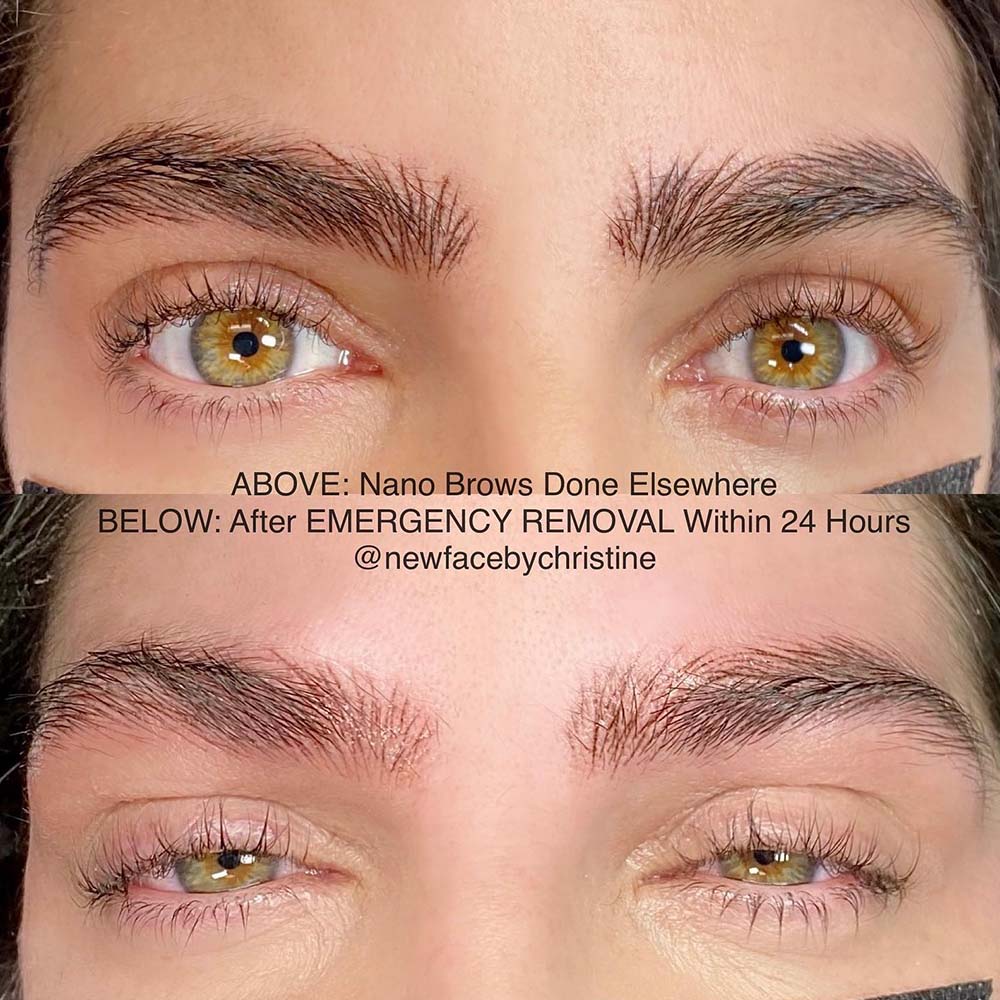 Tattooed Eyebrows Gone Wrong: What Can Happen and What to Do?