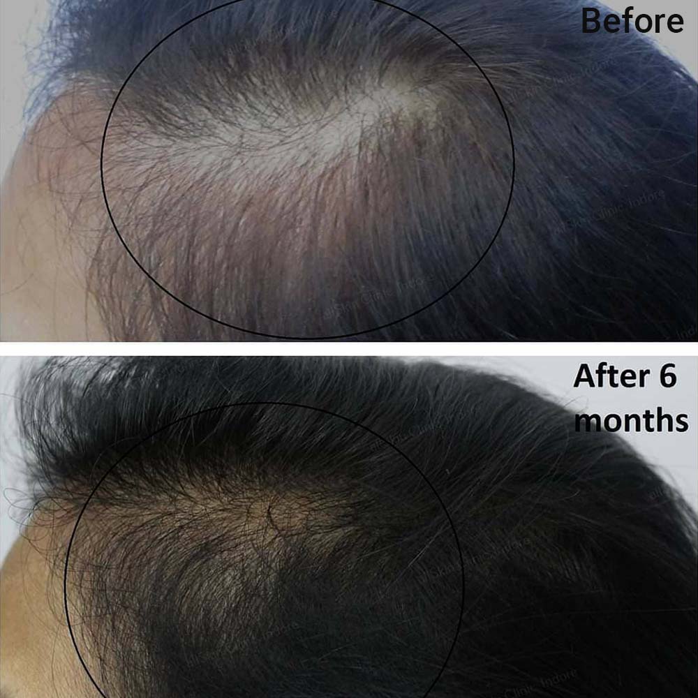 How Is Derma Roller Hair Regrowth Done?