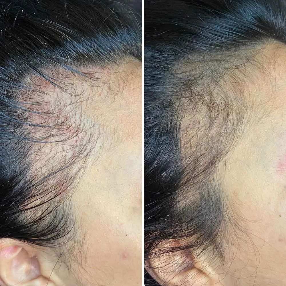 Dermaroller for sales hair loss