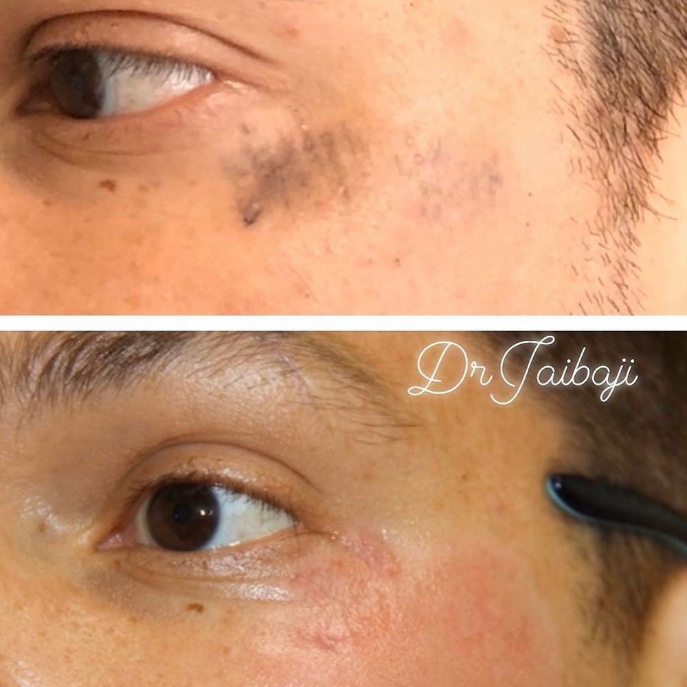 How Much Does Dermabrasion Cost?