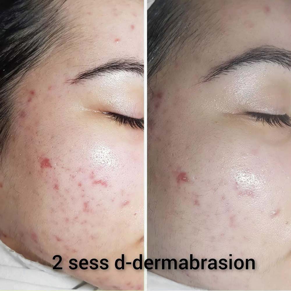 Dermabrasion - Everything You Need to Know About the Treatment