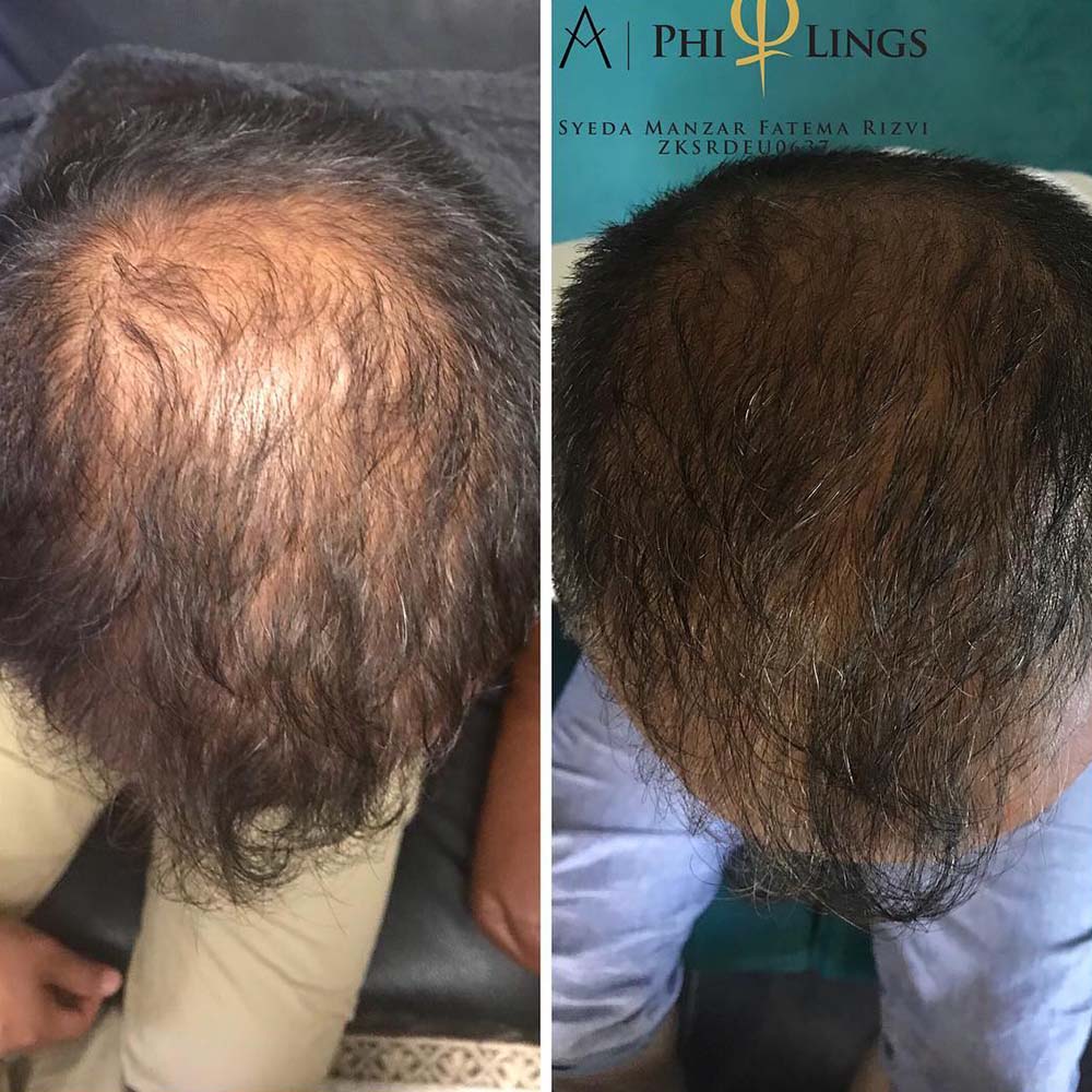 Are There Any Side Effects For Dermarolling Hair?