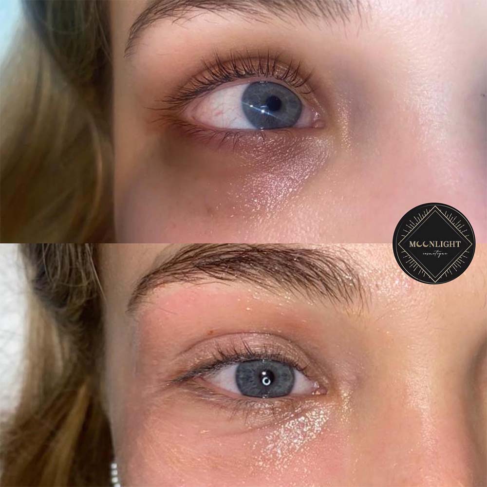 How Is Under Eye Concealer Tattoo Techniques Done?
