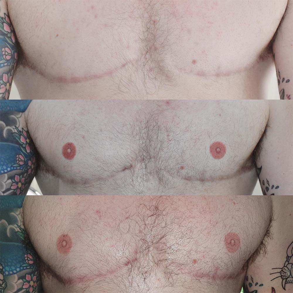 Men's Nipple Tattoo - What's Male Areola Reconstruction Like?