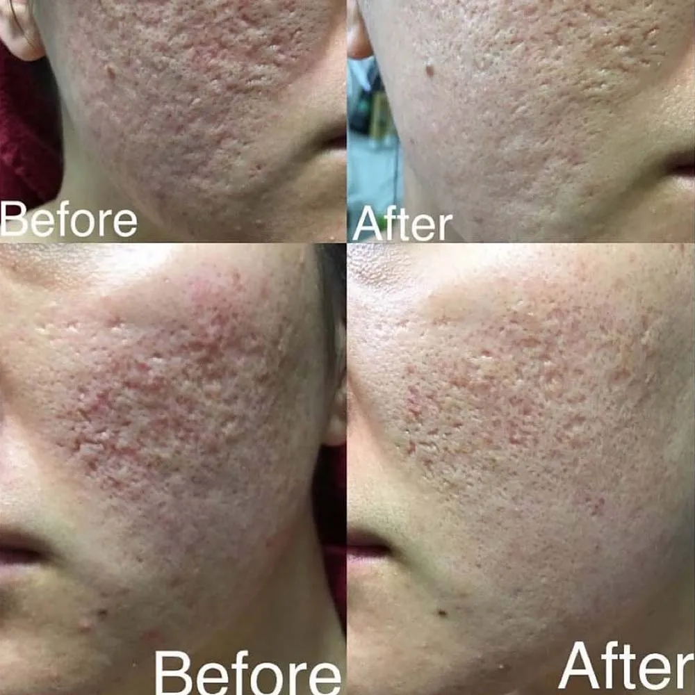 Microneedling is a skin treatment that can be used in many areas of the face and body, even the scalp.