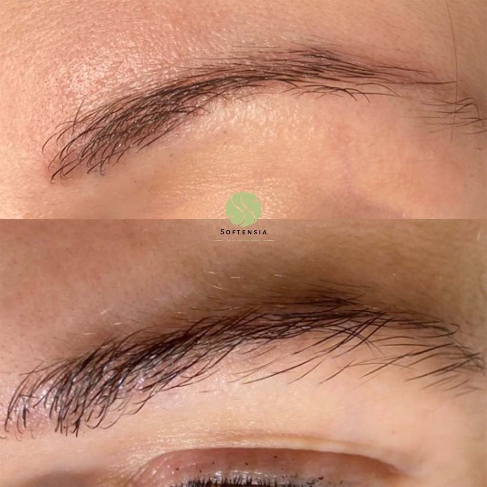 What’s Microneedling for Eyebrows Like?