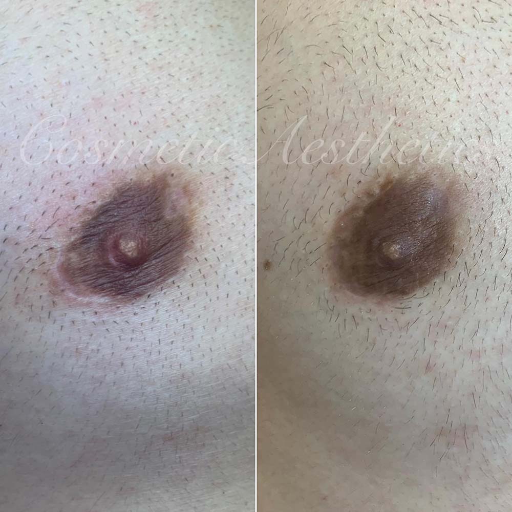 What’s Nipple and Areola Micropigmentation?