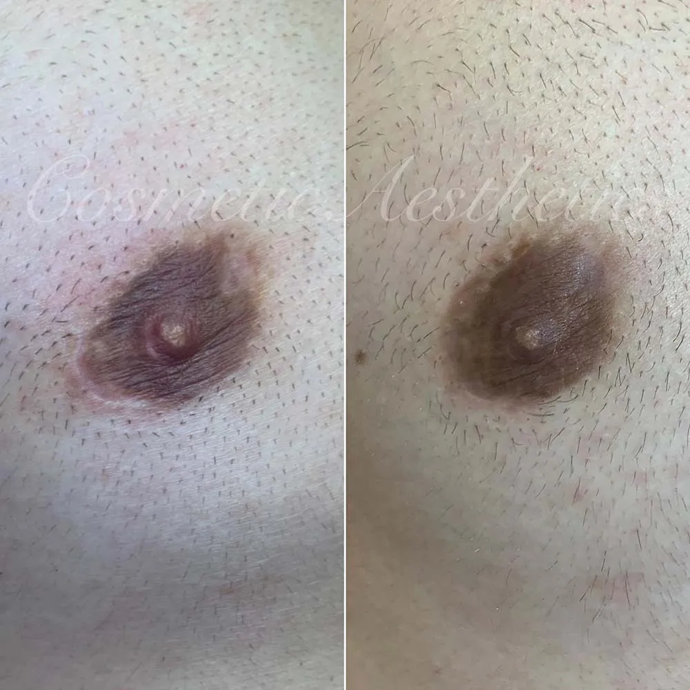 What’s Nipple and Areola Micropigmentation?
