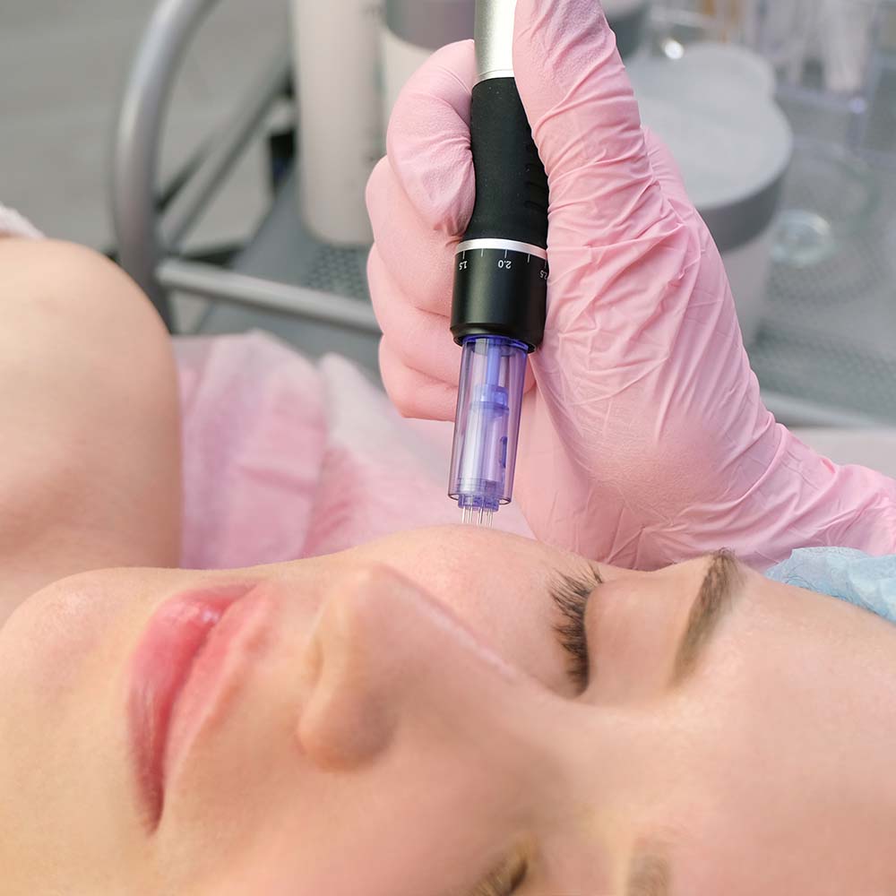 What Is Microneedling Treatment And What Involves?
