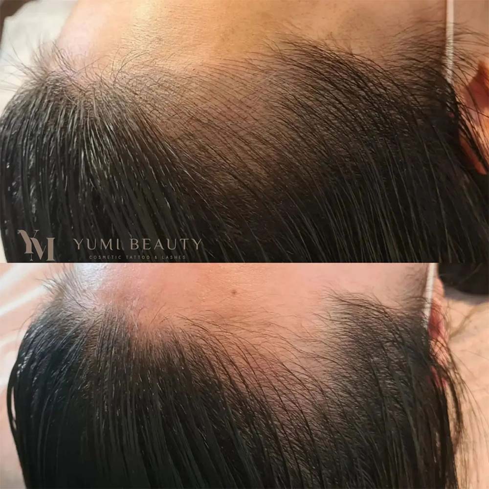Hairline Tattoo - Cosmetic Tattoo for a Receding Hairline