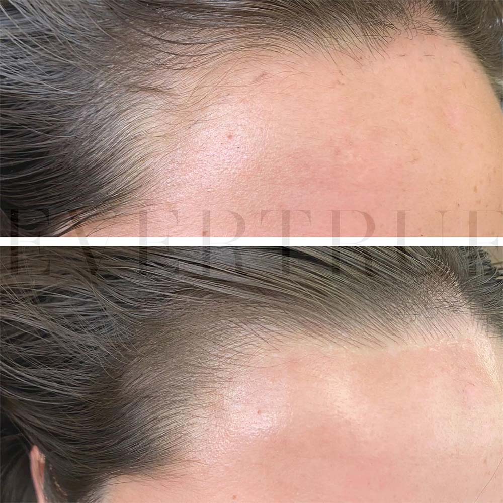 Hairline Tattoo - Cosmetic Tattoo for a Receding Hairline
