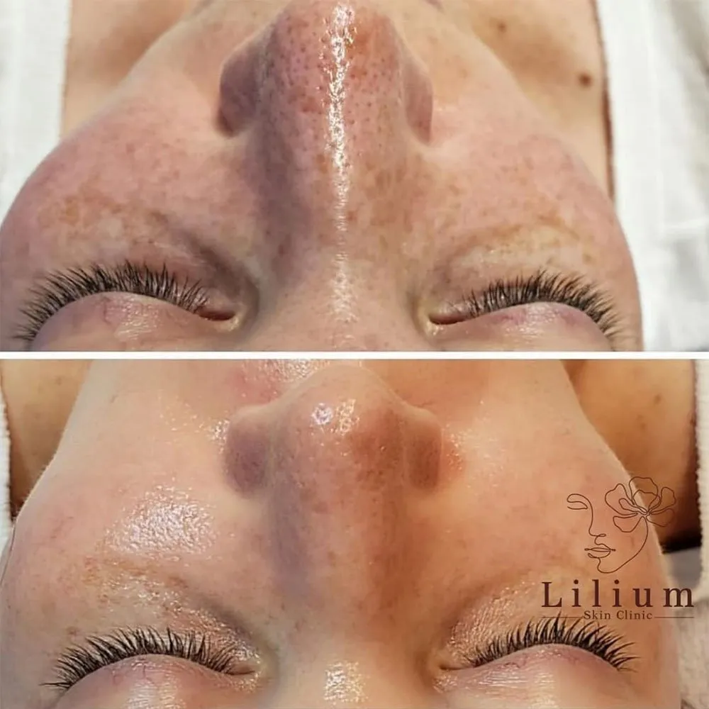 Hydradermabrasion (also known as Hydrafacial or Wet Dermabrasion) cleanses and hydrates skin