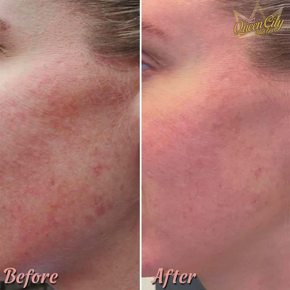 What Happens to Hyperpigmentation After 1 Session of Microneedling?