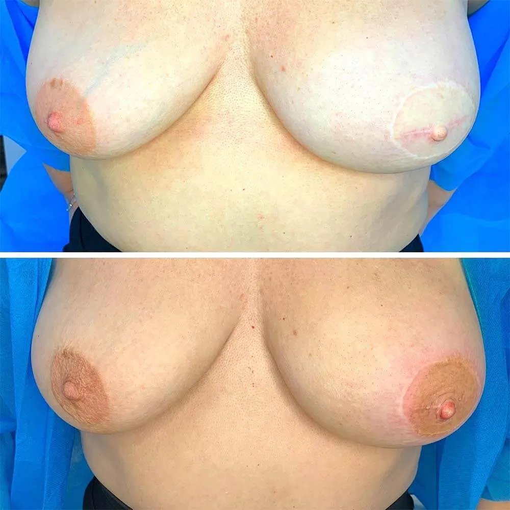 nipple tattoo before and after