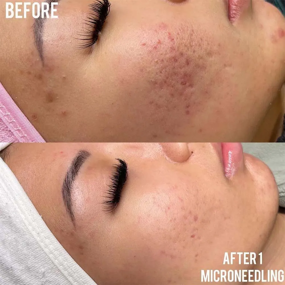 What Happens to Scars After 1 Session of Microneedling?